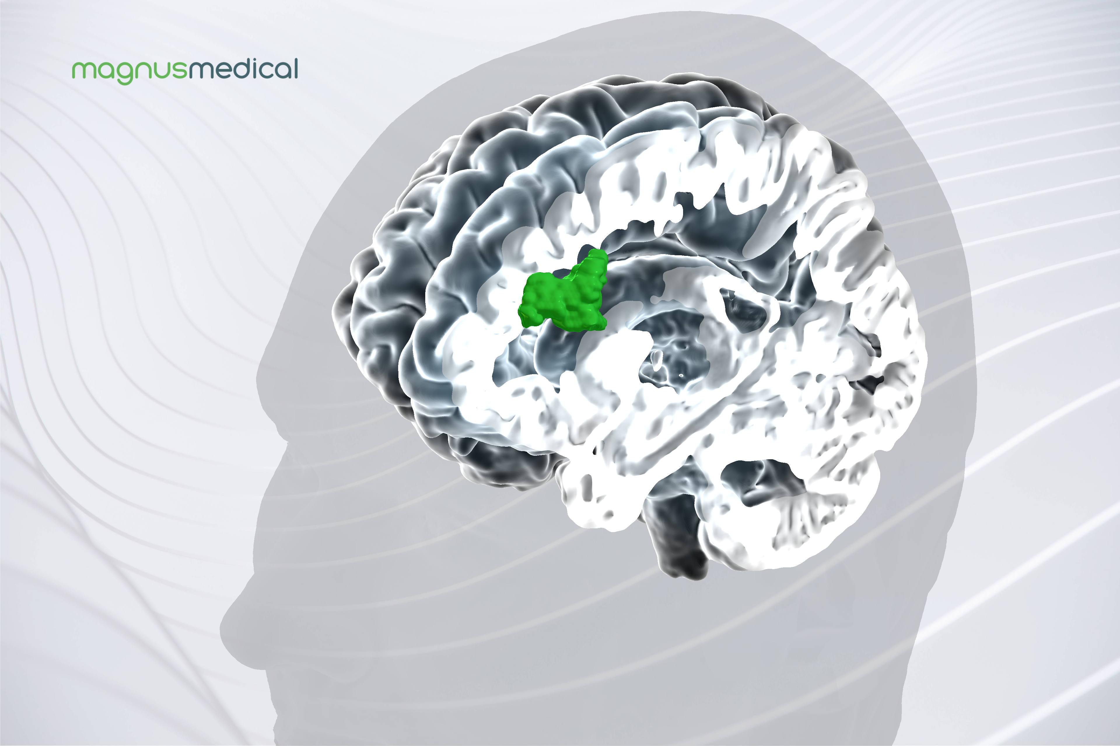 MagnusMedical brain image highlighting SAINT Neuromodulation